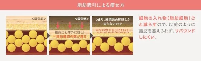 脂肪吸引による痩せ方