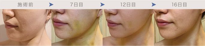頬・顎下の脂肪吸引7～16日後のダウンタイム経過写真