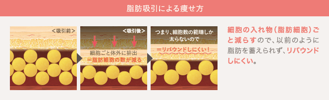 脂肪吸引による痩せ方