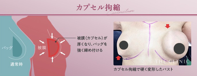 カプセル硬縮の様子