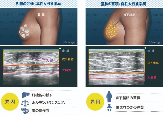 真性女性化乳房と偽性女性化乳房について