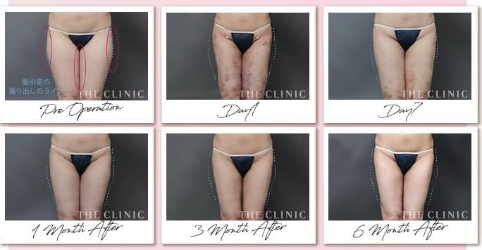 太もも脂肪吸引の症例写真