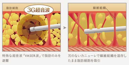 ベイザー脂肪吸引のしくみ