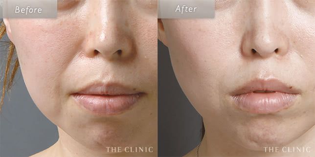 顔の脂肪注入の症例