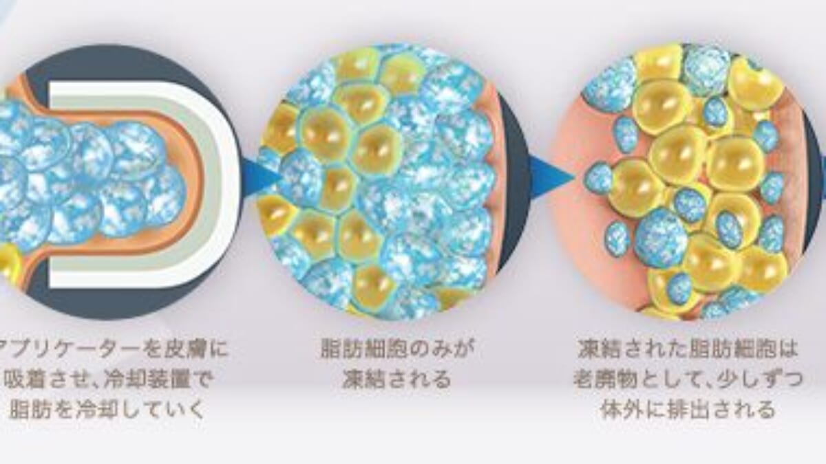 二の腕の脂肪冷却は効果がありますか？｜THE CLINIC（ザクリニック