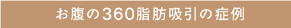 お腹の360脂肪吸引の症例