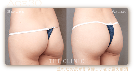 25歳 HIP MAKE by 360°脂肪吸引の症例 除去した脂肪を活用して丸いお尻にチェンジ