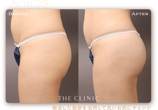 30歳 HIP MAKE by 360°脂肪吸引の症例 垂れたお尻が引き締まり老け見え解消