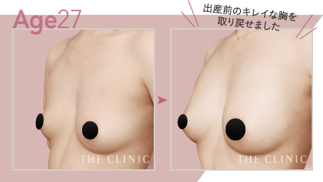 Age.27 出産前のキレイな胸を取り戻せました