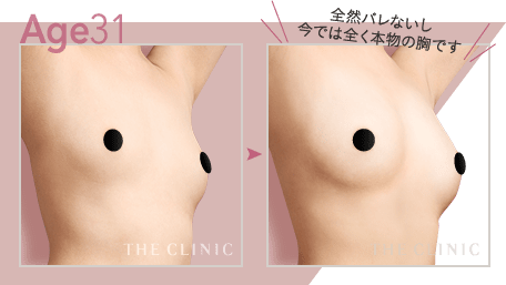 Age.31 全然バレないし今では全く本物の胸です