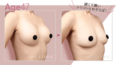 Age.47 硬くて痛いシリコンとおさらば!