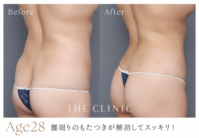 Age28 腰周りのもたつきが解消してスッキリ！