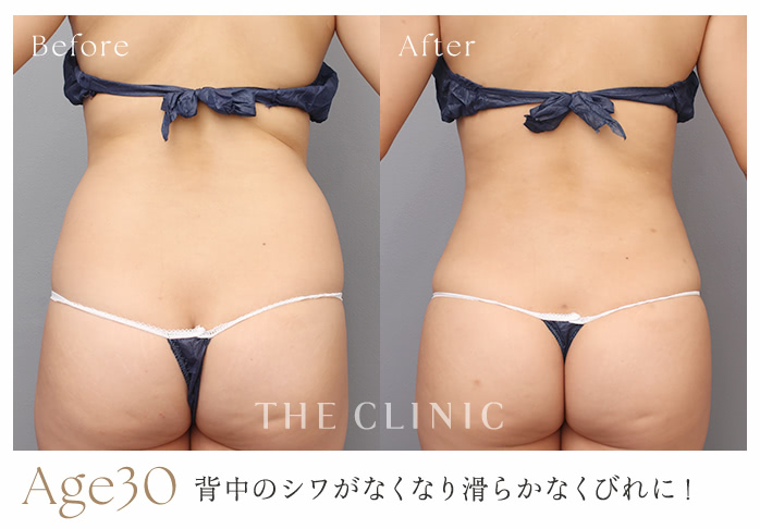 Age30 背中のシワがなくなり滑らかなくびれに！