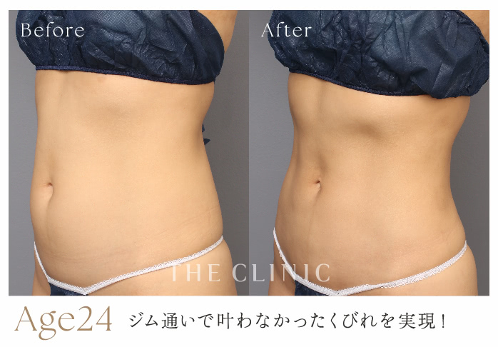 Age24 ジム通いで叶わなかったくびれを実現！
