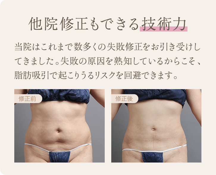 他院修正もできる技術力 | 当院はこれまで数多くの失敗修正をお引き受けしてきました。失敗の原因を熟知しているからこそ、脂肪吸引で起こりうるリスクを回避できます。