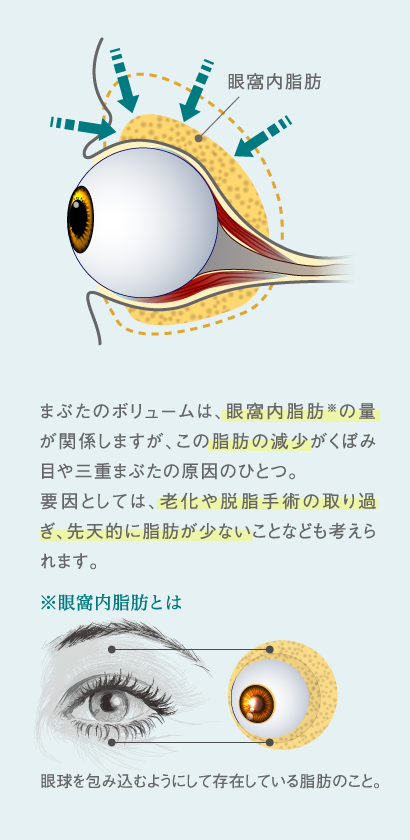 まぶたのボリュームは、眼窩内脂肪※の量が関係しますが、この脂肪の減少がくぼみ目や三重まぶたの原因のひとつ。要因としては、老化や脱脂手術の取り過ぎ、先天的に脂肪が少ないことなども考えられます。