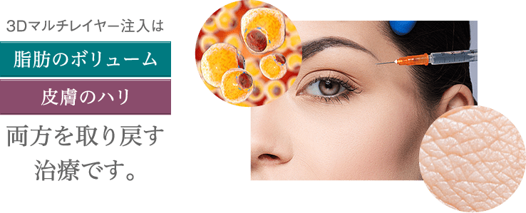 3Dマルチレイヤー注入は「脂肪のボリューム」「皮膚のハリ」両方を取り戻す治療です。