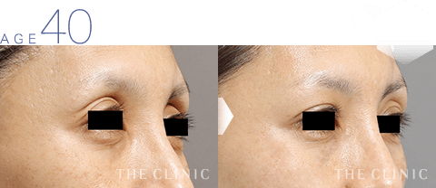 40歳女性 目の上の窪みの脂肪注入 症例画像