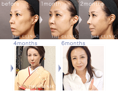 顔の脂肪注入の術後経過