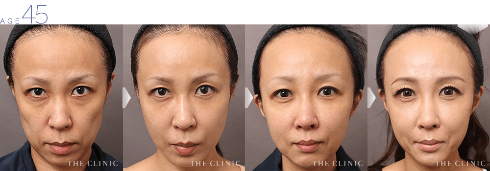 45歳女性 頰のコケ・おでこの窪み・唇のシワ