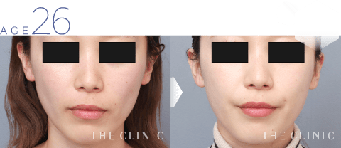26歳女性 頬のこけの脂肪注入 症例画像