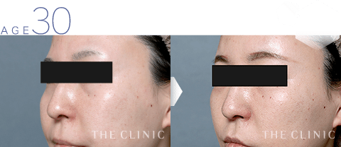 30歳女性 目の下の窪みの脂肪注入 症例画像