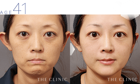 41歳女性 頬のこけ・目の下のクマ・唇のシワの脂肪注入 症例画像
