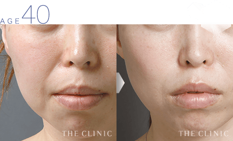 40歳女性 ほうれい線 症例画像