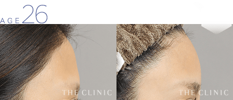 26歳女性 おでこの窪みの脂肪注入 症例画像