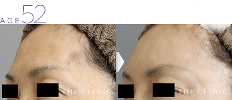 52歳女性 こめかみの窪みの脂肪注入 症例画像