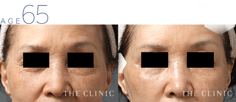 65歳女性 おでこのシワ・目の下のシワの脂肪注入 症例画像