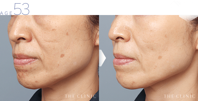 53歳女性 目の下のシワ・頬・ほうれい線 症例画像