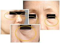 顔の脂肪注入症例