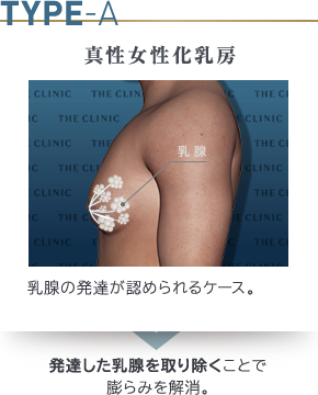 真性女性化乳房とは、女性のバストと同じように乳腺自体が発達して胸が膨らんでしまう症状です。 乳腺の周りには皮下脂肪も増加しています。
