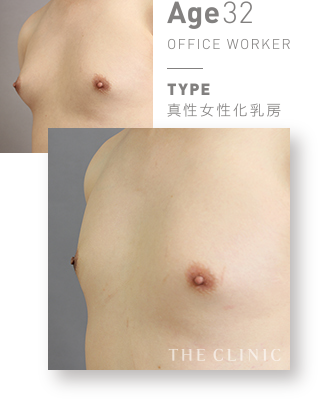 真性女性化乳房(男性の胸の膨らみ)の乳腺除去の症例写真【32歳男性】 |THE CLINIC 女性化乳房外来|