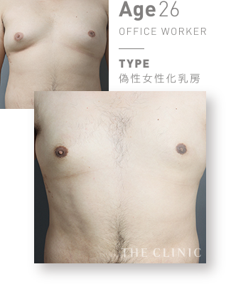 偽性女性化乳房（男性の胸の膨らみ）のVASER脂肪吸引(ベイザーリポ)の症例写真【26歳男性】 |THE CLINIC 女性化乳房外来｜