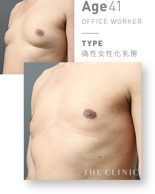 偽性女性化乳房（男性の胸の膨らみ）のVASER脂肪吸引(ベイザーリポ)の症例写真【41歳男性】 |THE CLINIC 女性化乳房外来｜
