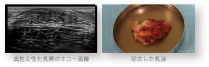 真性女性化乳房のエコー画像 / 除去した乳腺