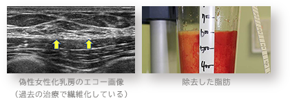偽性女性化乳房のエコー画像(過去の治療で繊維化している) / 除去した脂肪