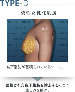 偽性女性化乳房とは、肥満によって胸に皮下脂肪がついたことで、女性のように胸が膨らんでしまった症状です。原因は、肥満によって胸に皮下脂肪がついてしまうことと、生まれつきの２つが考えられます。