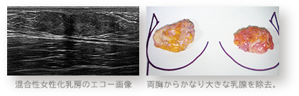 混合性女性化乳房のエコー画像 / 両胸からかなり大きな乳腺を除去。
