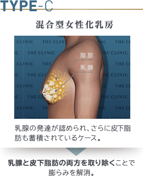 混合型女性化乳房とは、女性のバストのように乳腺が発達し、かつ肥満によって胸に脂肪がついているタイプを指します。エコー検査や触診で判別ができます。 ふくらみの程度や形には個人差があります。