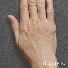 55歳／女性 before