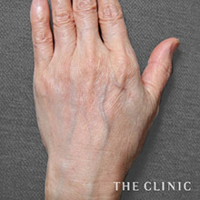 65歳／女性 before