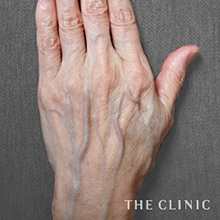 65歳／女性 before