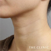 首のシワ before1