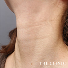 首のシワ before2