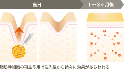脂肪幹細胞の再生作用で注入後から徐々に効果があらわれる