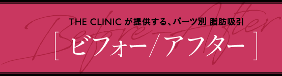 THE CLINICが提供する、パーツ別 脂肪吸引 [ ビフォー／アフター ]