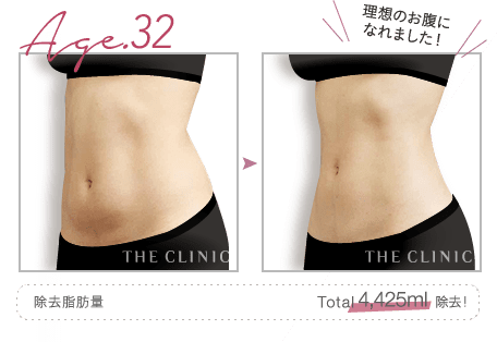 Age.32 理想のお腹になれました！ | 除去脂肪量: Total 4,425ml 除去！